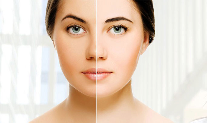 تاثیر زالو درمانی بر لک و روشن شدن پوست صورت